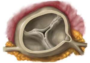 Aortenklappenstenose